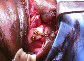 Image of an eye injury caused by a tree branch trauma
